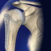 L-Fracture Shoulder