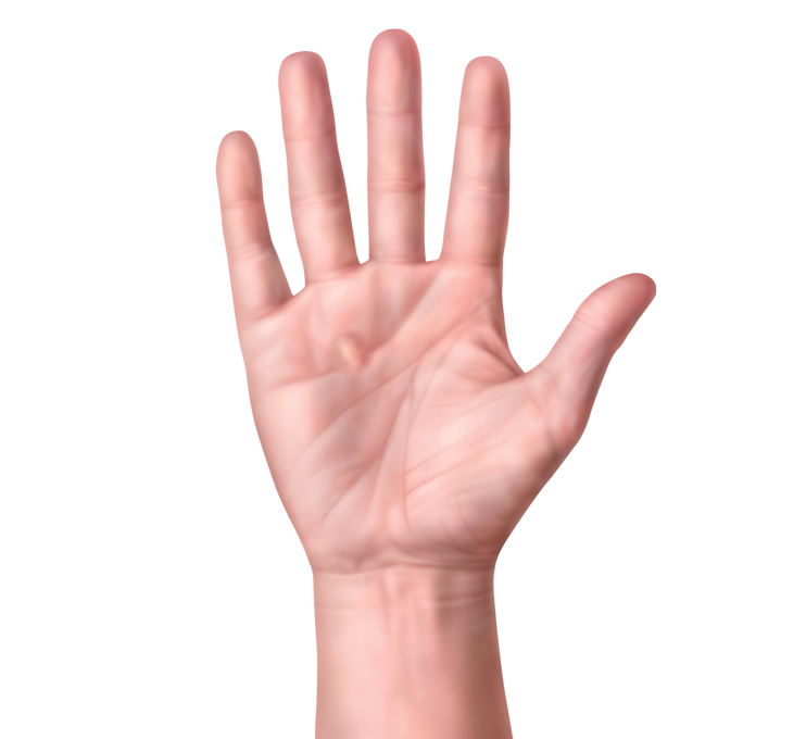 Contracture of L- Hand