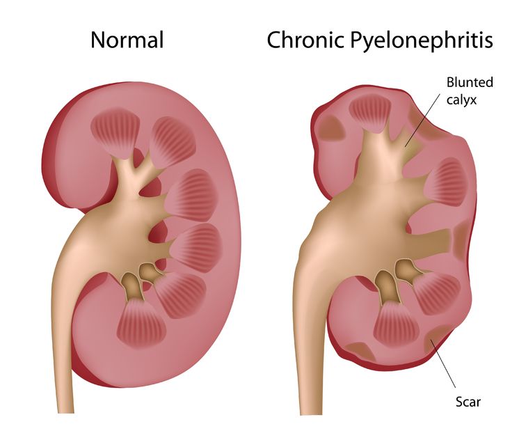 Kidney Pyelonephritis