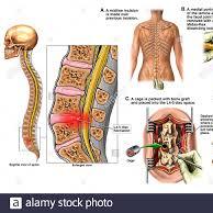 L4-L5 Disc Herniation