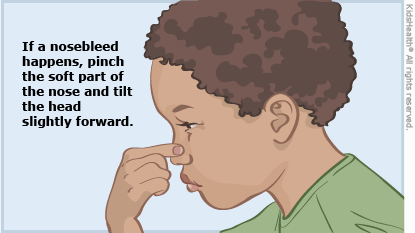 Nose Bleeding